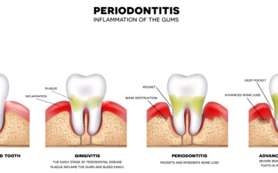 Why Should I Care About Periodontal Disease?