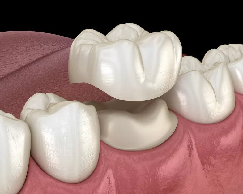dental-crown-st-paul-dentist-Chalet-Dental-Care