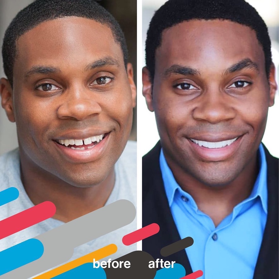 invisalign-before-after-St-Paul-cosmetic-dentist