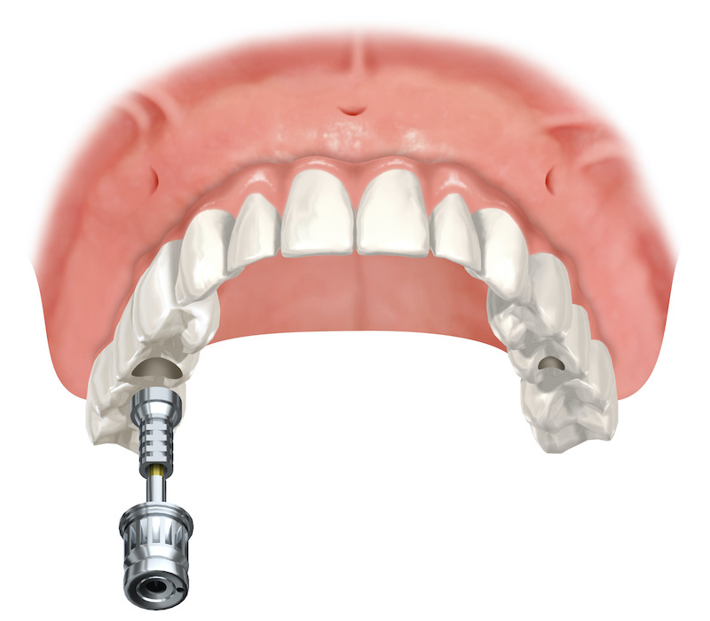 Dental-Implant-graphic-Chalet-Dental-Care