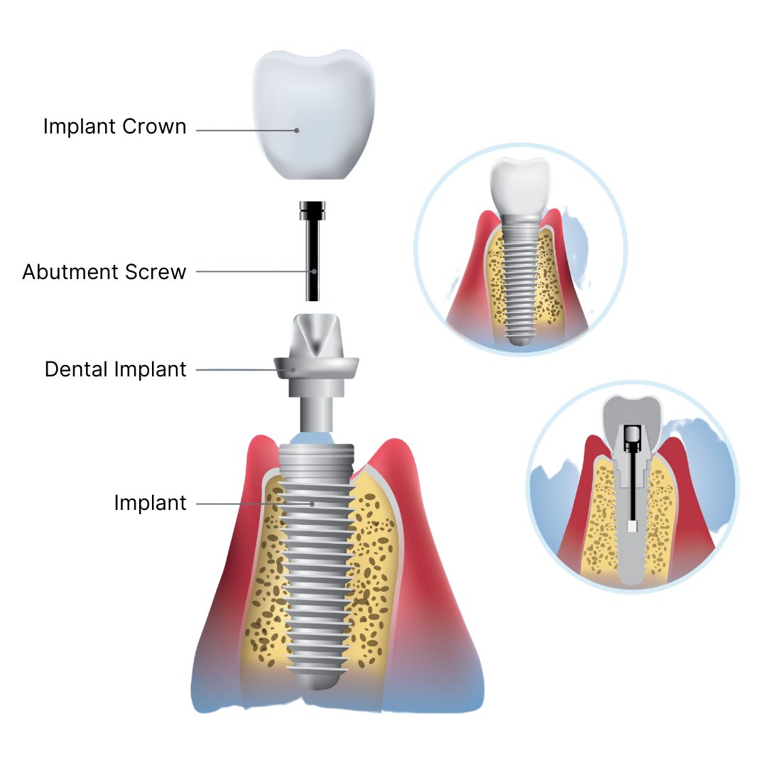 Dental-Implant-graphic-Chalet-Dental-Care