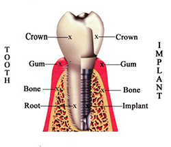 dental implants St. Paul - Chalet Dental Care