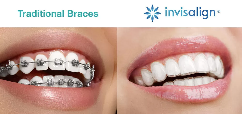 invisalign clear aligners and wire braces